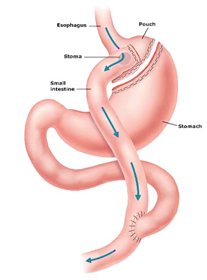 Laparoscopic Gastric Bypass Michigan Gastric Bypass Diagram